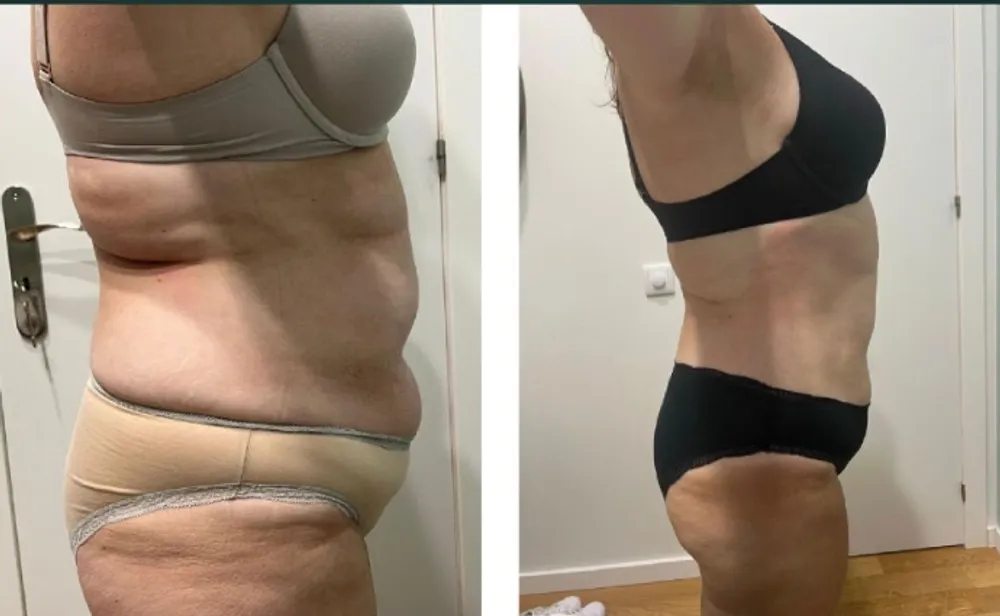 Antes e depois — abdómen e flancos