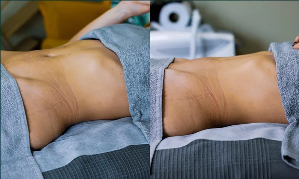 Antes e depois — retenção e inchaço no abdómen